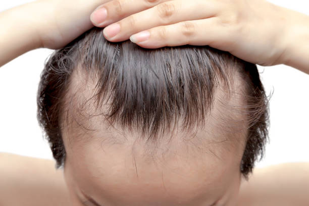 hair fall treatment options