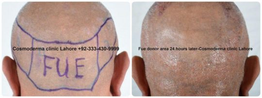 hair regrowth after Fue hair transplant donor area