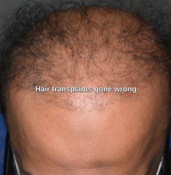 Bad hair transplant results