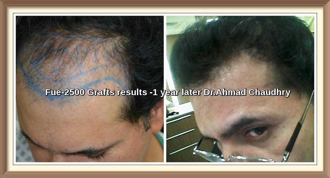DHI FUE Hair Transplant Results Lahore Pakistan