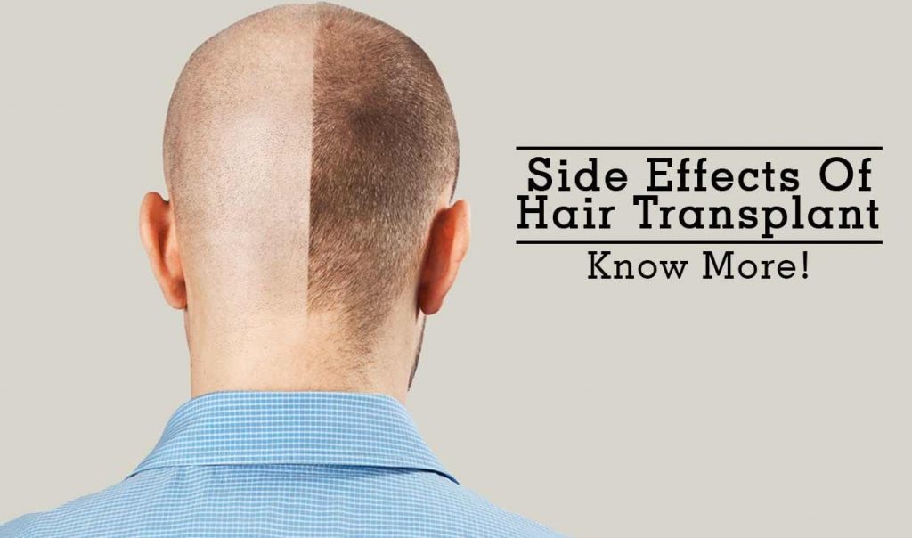 what are side effects of hair transplant