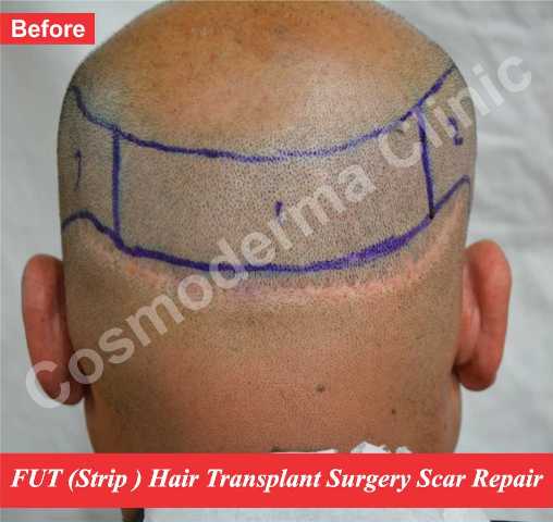 FUT hair restoration surgery scar