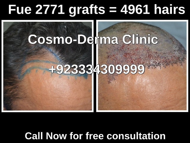 Fue hair transplant specialist clinic Lahore