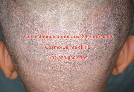 Fue technique donor area healing