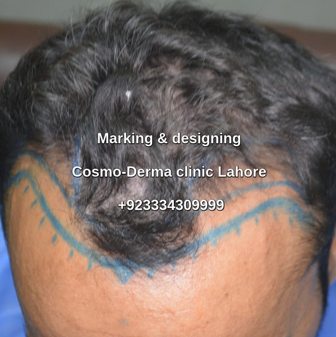 Marking -designing before Fue procedure