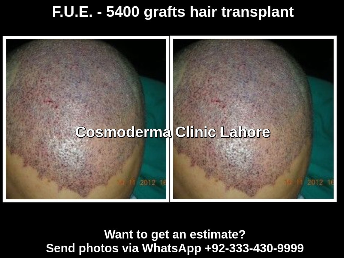 Hair regrowth techniques Lahore