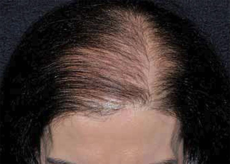 female hair frontal thinning