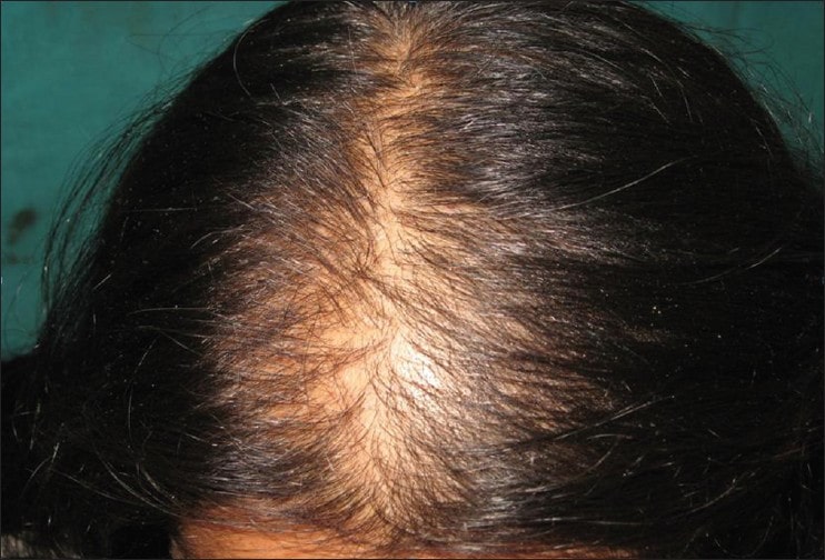 women hair loss clinic Lahore Pakistan