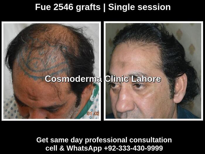 Fue 2546 grafts results