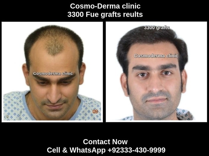 Fue 3300 grafts hair transplant result Lahore Pakistan