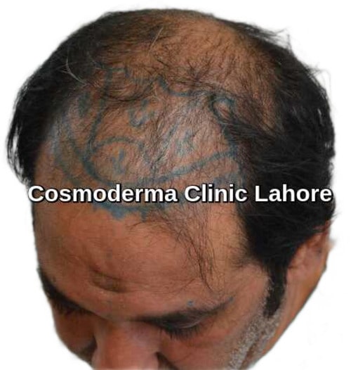 Left sided view before Fue hair transplant clinic Lahore