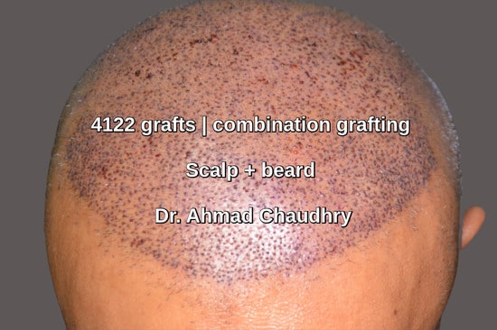 Combination grafting scalp beard