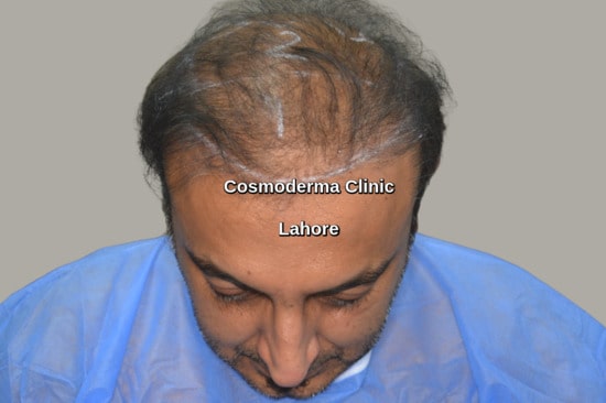 FUT hair transplant poor result