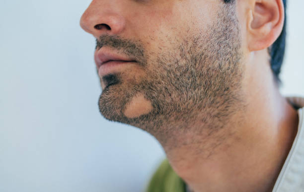 Alopecia Areata Barbae Lahore Pakistan