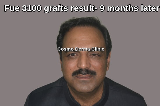 Amazing 3100 grafts hair transplant results Lahore Pakistan