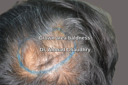 Crown hair loss area marking