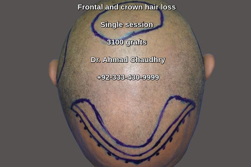 Front crown baldness treatment Lahore Pakistan