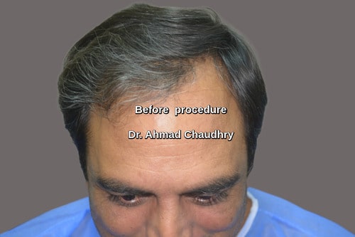 Frontal hair loss before procedure