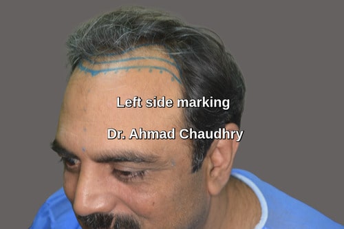 Left side marking before fue hair transplant