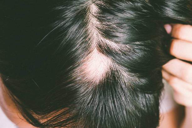 Patchy hair loss spot treatment Lahore Pakistan