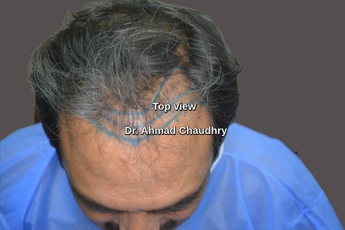 Top view frontal baldness marking