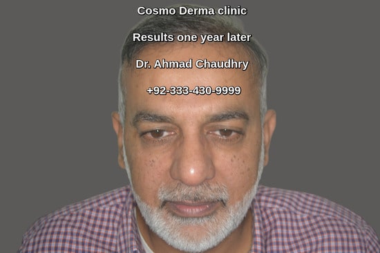 Follicular unit extraction result Lahore Pakistan one year later