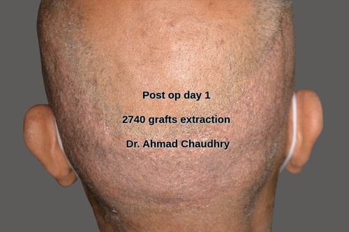 Fue 2740 donor area extraction