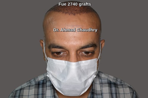Fue 2740 grafts hair transplant Lahore Pakistan