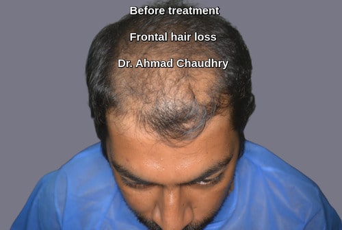 Front hair loss area before