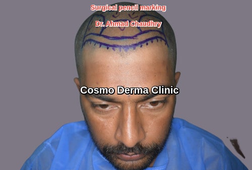 Marking designing before hair restoration surgery