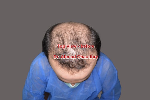 Baldness top view before Fue