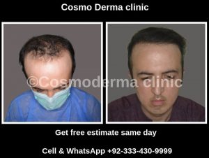 Fue hair transplant 2918 grafts results Lahore Pakistan