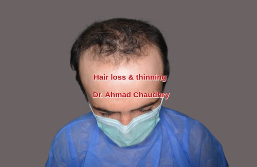 Hair loss before treatment