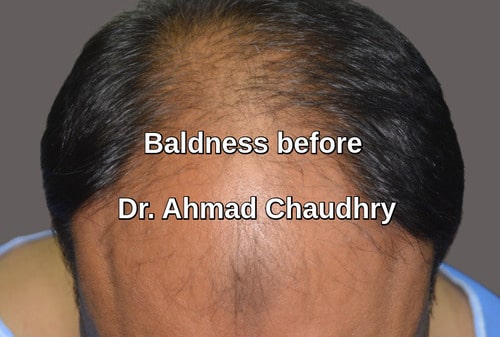 Inflammatory aspect baldness Lahore Pakistan