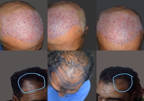 Fue hair transplant cost Lahore