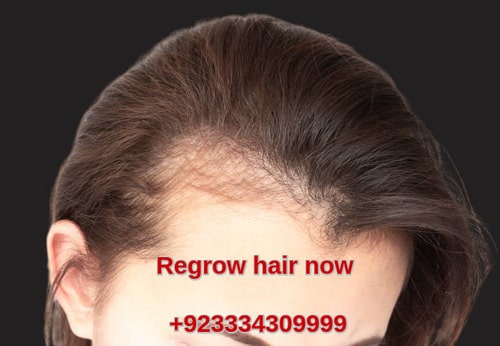 Hair thinning treatment Lahore Pakistan