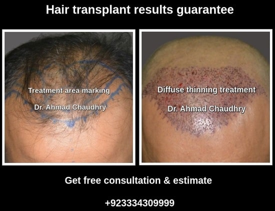 Hair after hair transplant