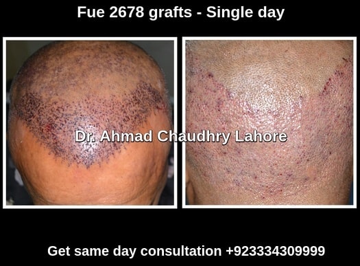 Hair restoration best treatment Lahore Pakistan