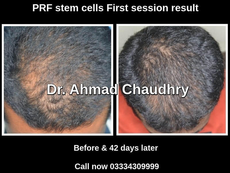 How to regrow hairs on a bald spot Lahore