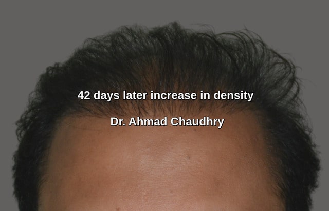 Transplanted hair density increase treatment Lahore
