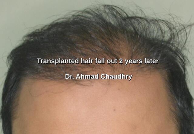 Transplanted hair fall out