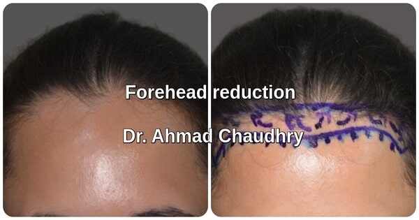 Female hair transplant Lahore patient