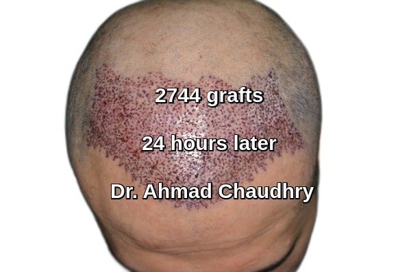 Shampoo after hair transplant Lahore