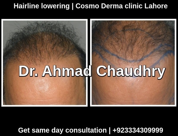 Ethnic considerations hair restoration Asian patient