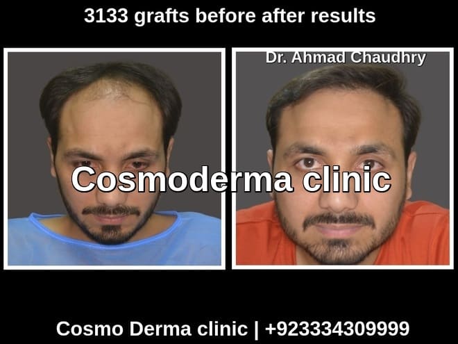 3133 grafts before after result Lahore
