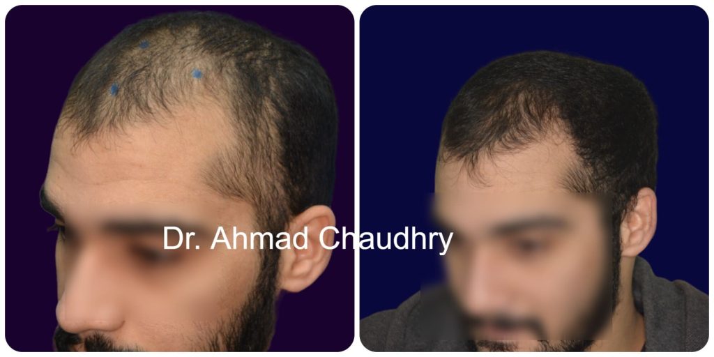 Best hair regrowth treatment result Lahore Pakistan