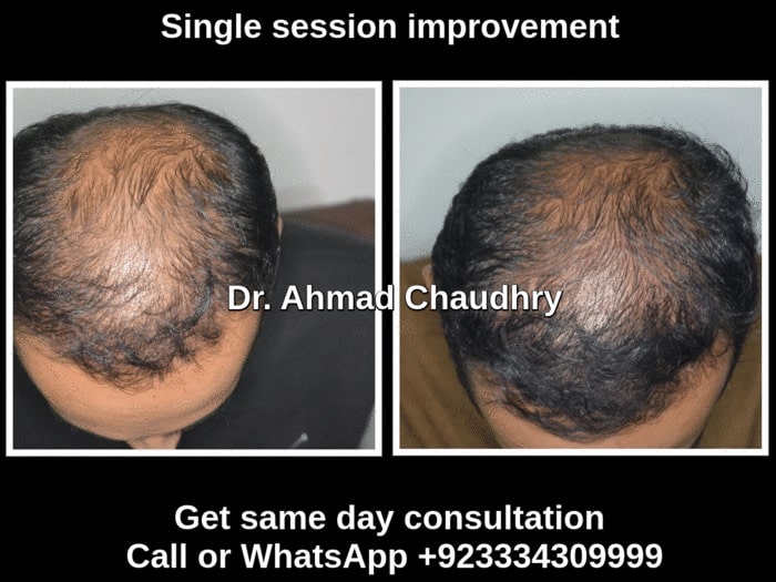 Top hair loss treatment Lahore Pakistan