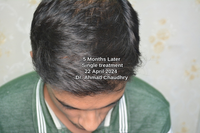 hair regrowth naturally specialist clinic Lahore result