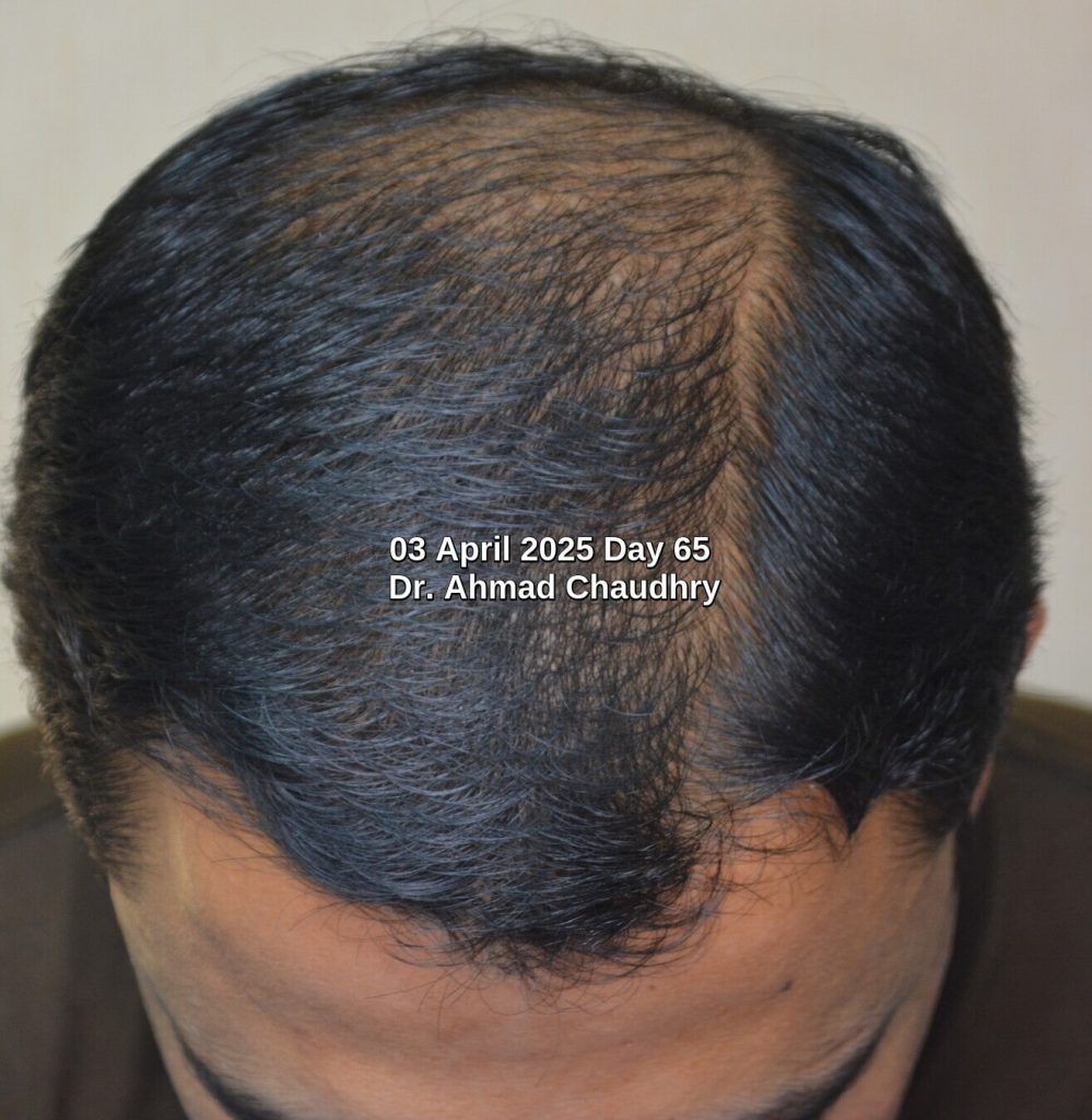 65 days after hair regrowth treatment