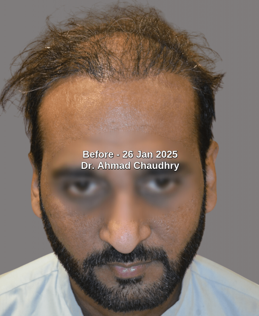 Bad hair transplant density results Bad hair transplant density results